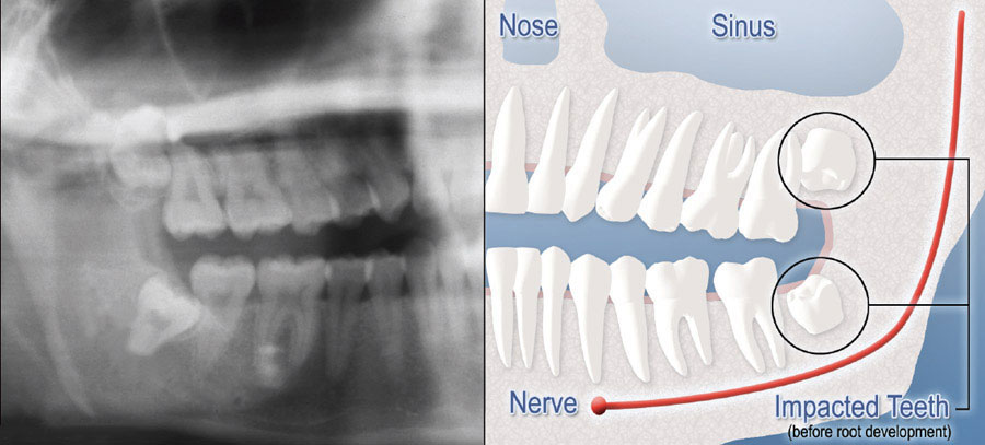 A side-by-side x-ray and diagram depicting impacted wisdom teeth