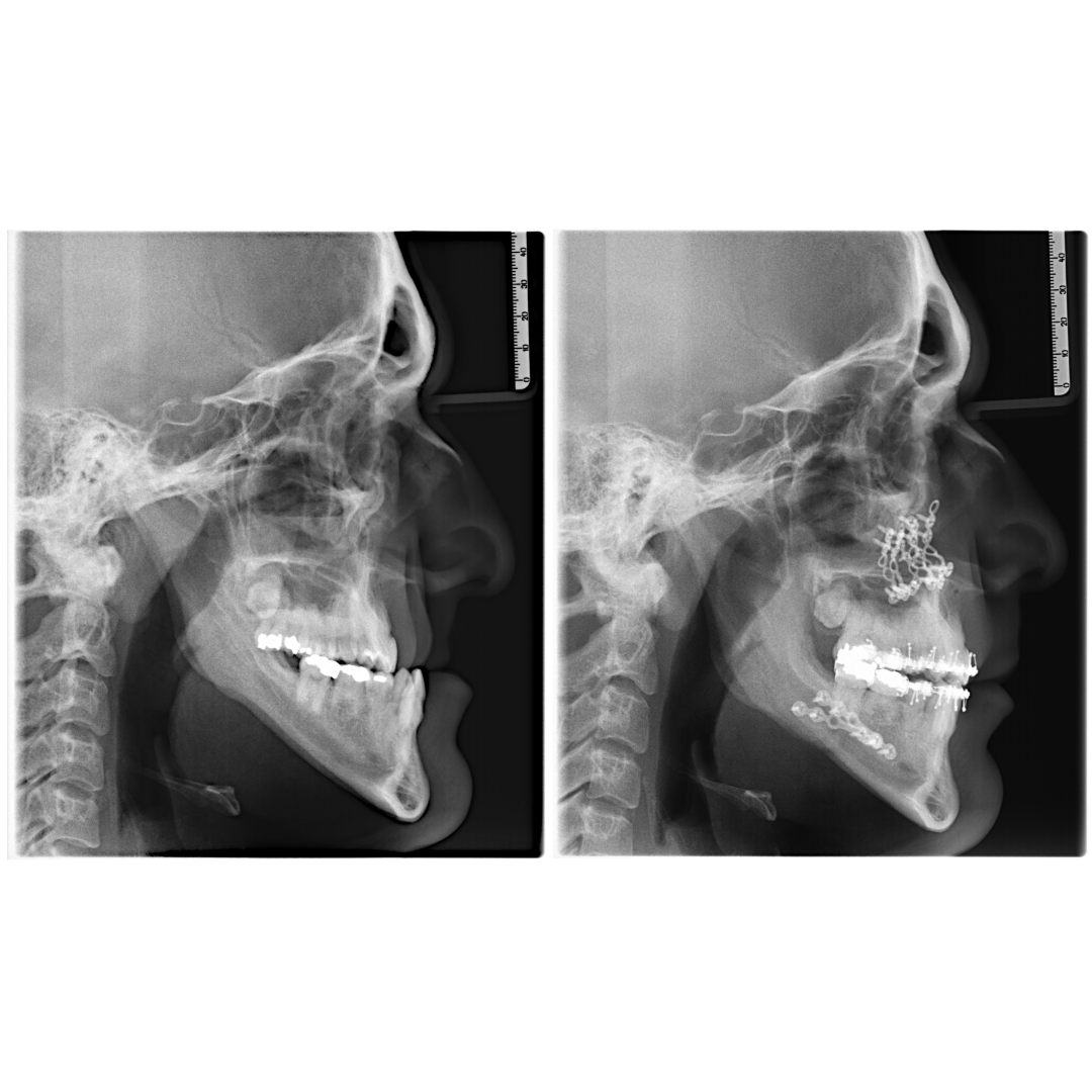 Before and after corrective jaw surgery in Abilene at Abilene Surgical Associates