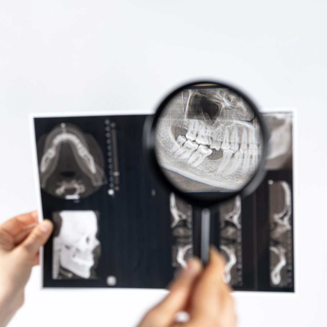 Female dental assistant holds magnifying glass in front of x-ray depicting temporomandibular joint disorder